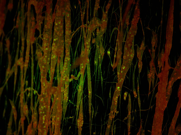 Un implant à ultrasons biodégradable aide la chimiothérapie à atteindre le cerveau