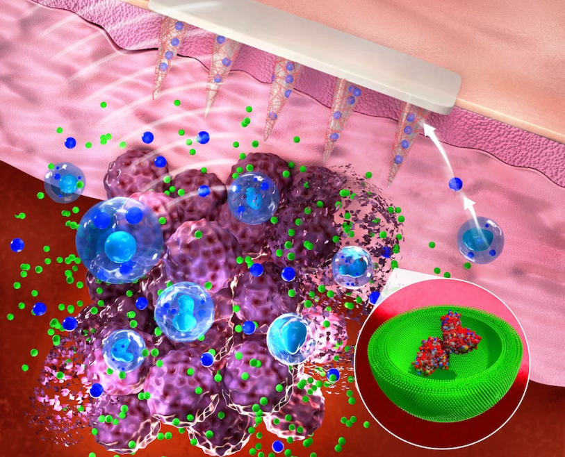 Le patch cutané à micro-aiguilles mesure les biomarqueurs du cancer