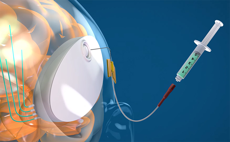 Dispositif rechargeable pour l'administration de médicaments au-delà de la barrière hémato-encéphalique : entretien avec Mike Maglin, PDG de CraniUS