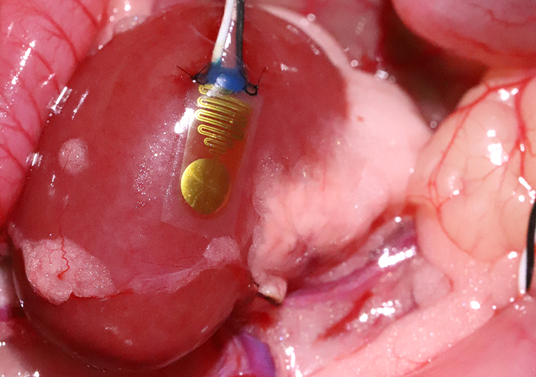 Un capteur surveille les organes transplantés à la recherche de signes de rejet