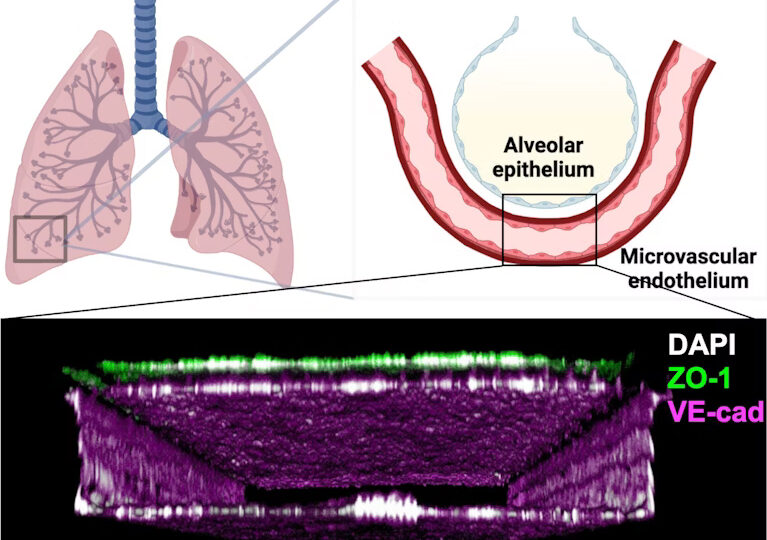 Une puce pulmonaire imite une radiothérapie