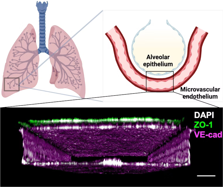 Une puce pulmonaire imite une radiothérapie