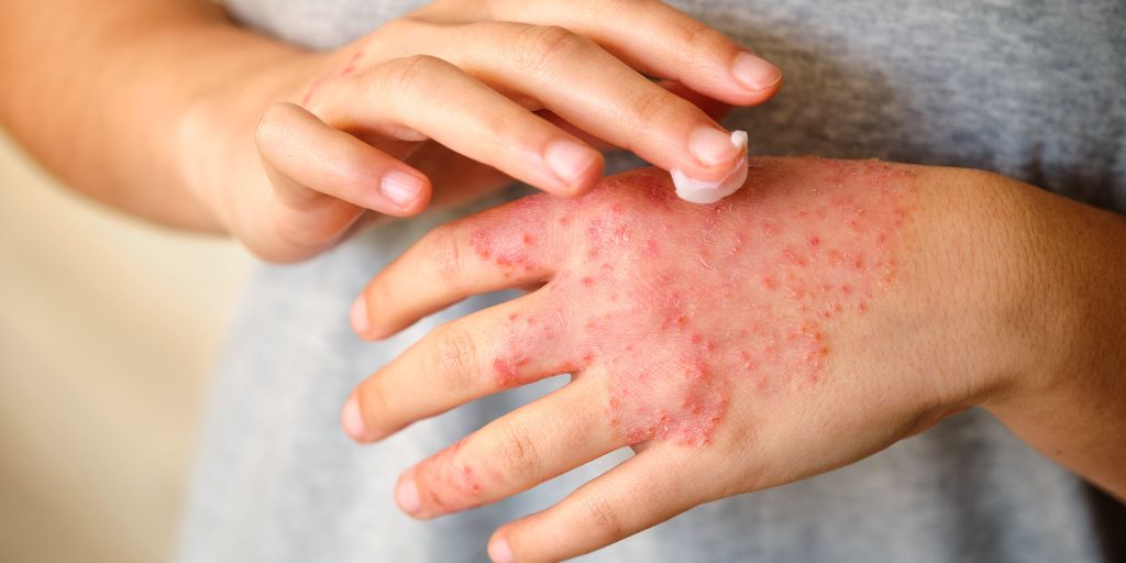 Une nouvelle étude donne aux personnes souffrant d'eczéma la liberté de choisir la fréquence de leurs bains